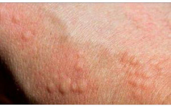 Urticaria