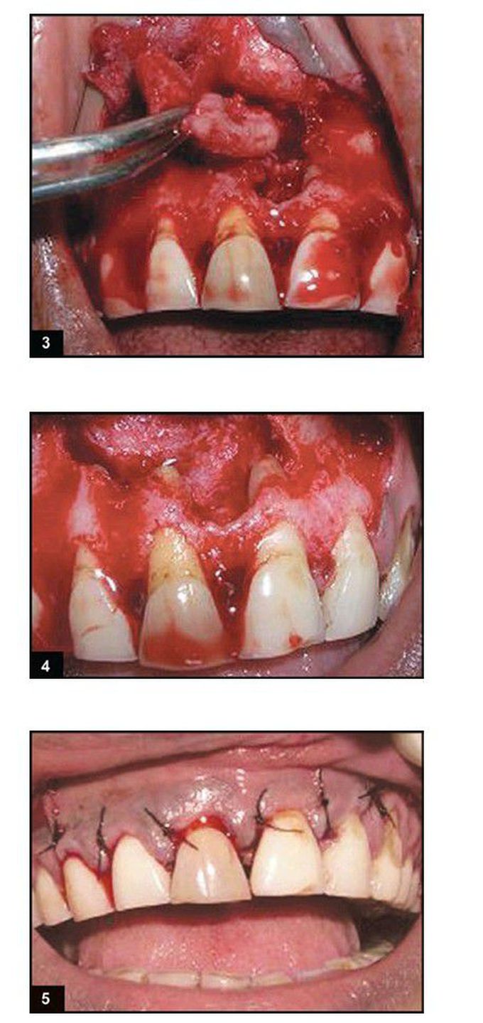 Surgical process for apicoectomy