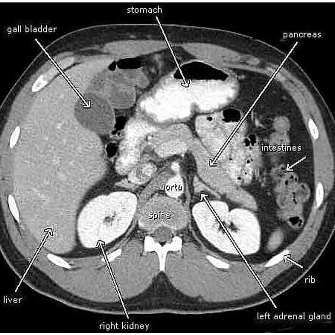 A normal CT scan of abdomen