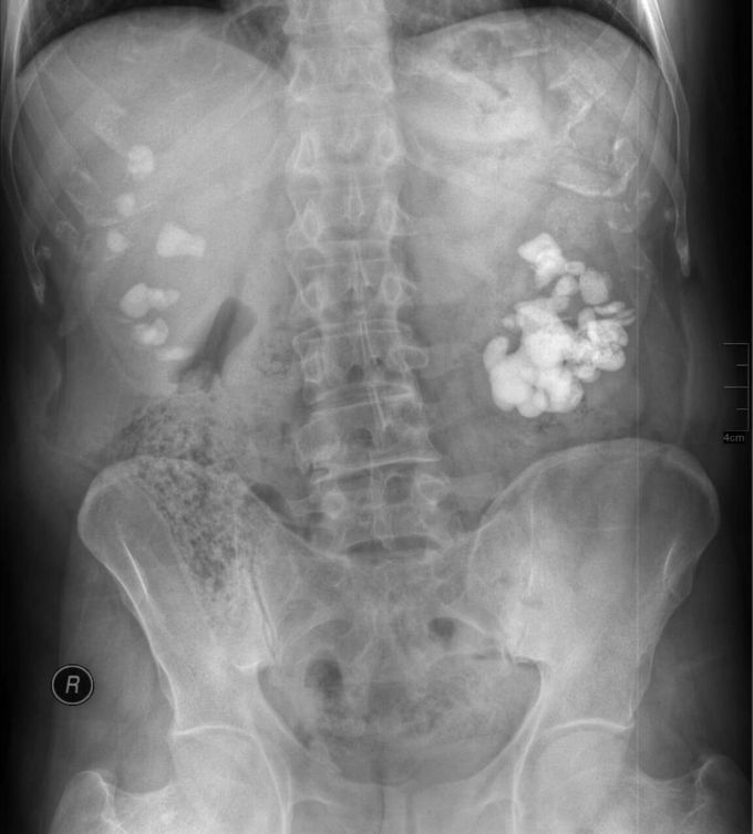 Staghorn calculus on the left & multiple renal stones on the right