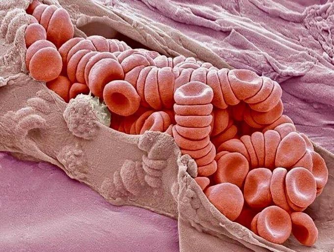 Ruptured venule