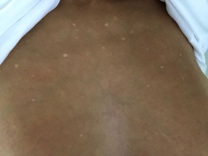 Skin dots