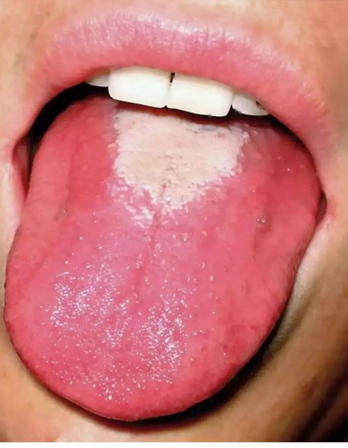 Strawberry Tongue