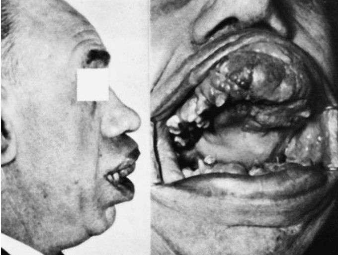 Hereditary gingivofibromatosis