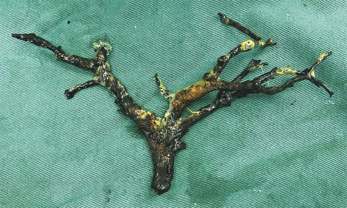 Biliary Cast Syndrome