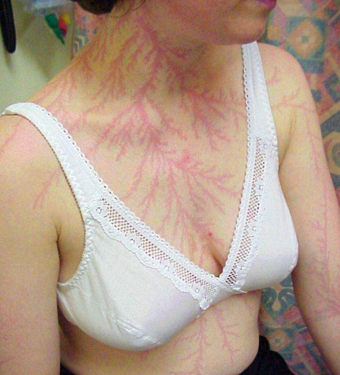 Blood vessels