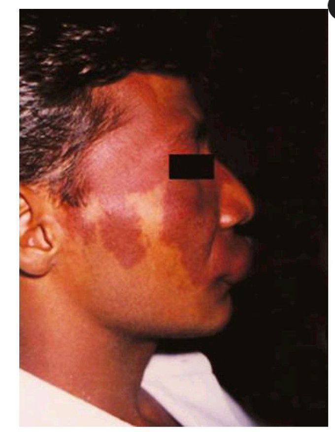 Red hemangioma