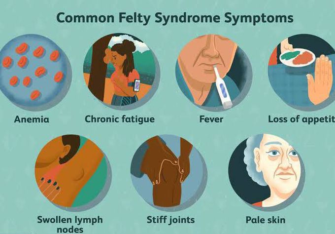 These are the symptoms of Common Felty syndrome