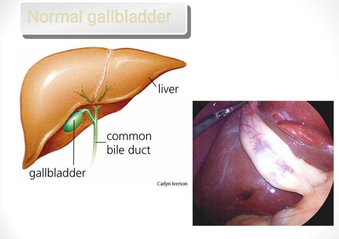 Normal Gallbladder