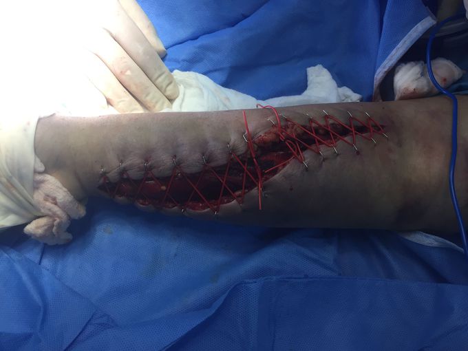 Arm fasciotomy closure