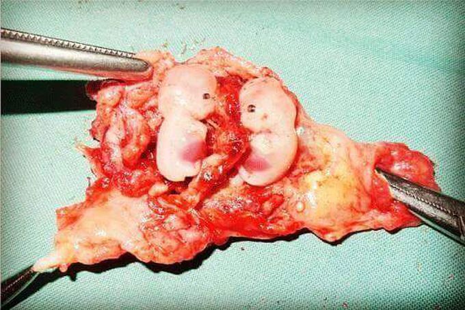 Ectopic tubal pregnancy