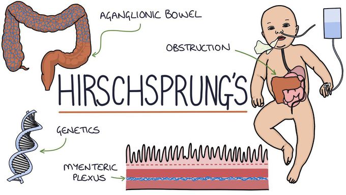 What is Hirschsprung disease