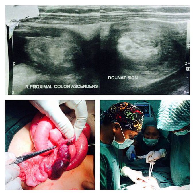 1 y.o boy with ileocolica intussusception