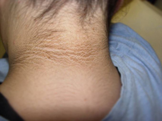 Acanthosis Nigricans