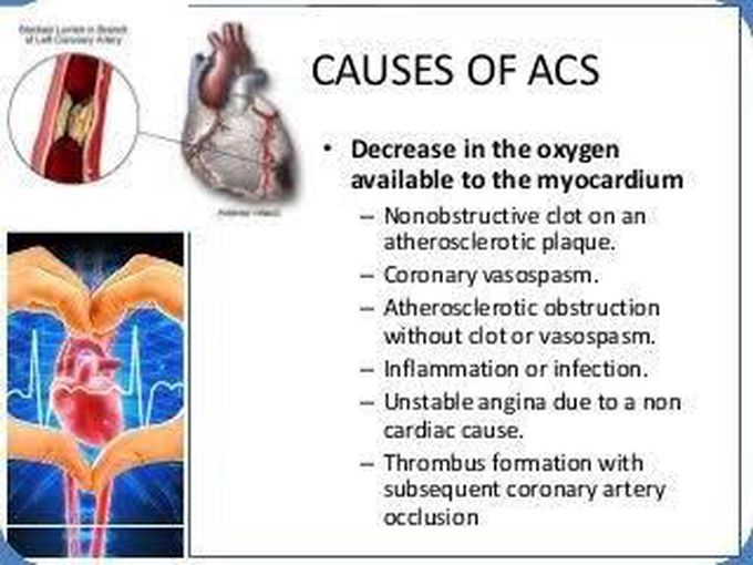 Causes of acute coronary syndrome