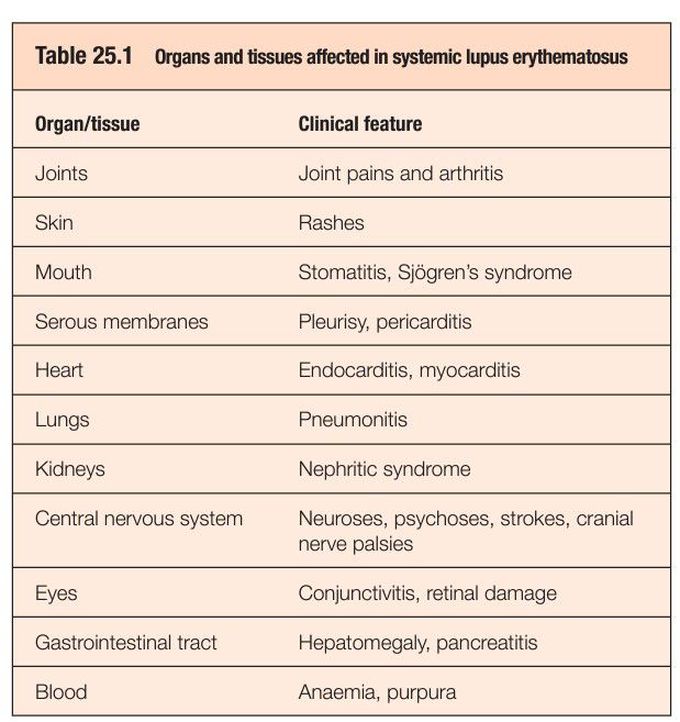 Systemic lupus erythematosus