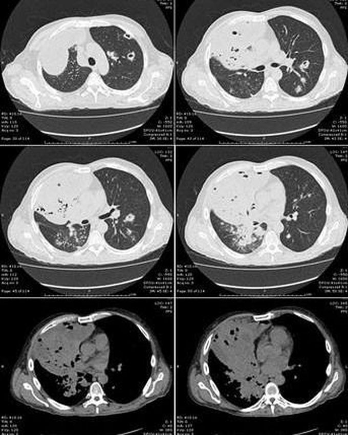 Pulmonary Nocardiosis