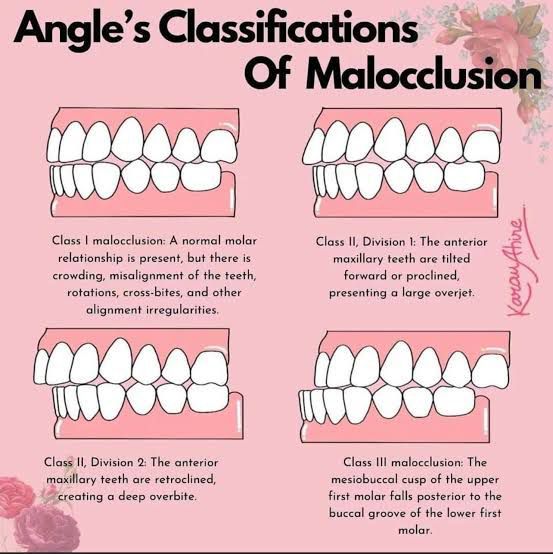 Angle's Classification of Occlusion - MEDizzy