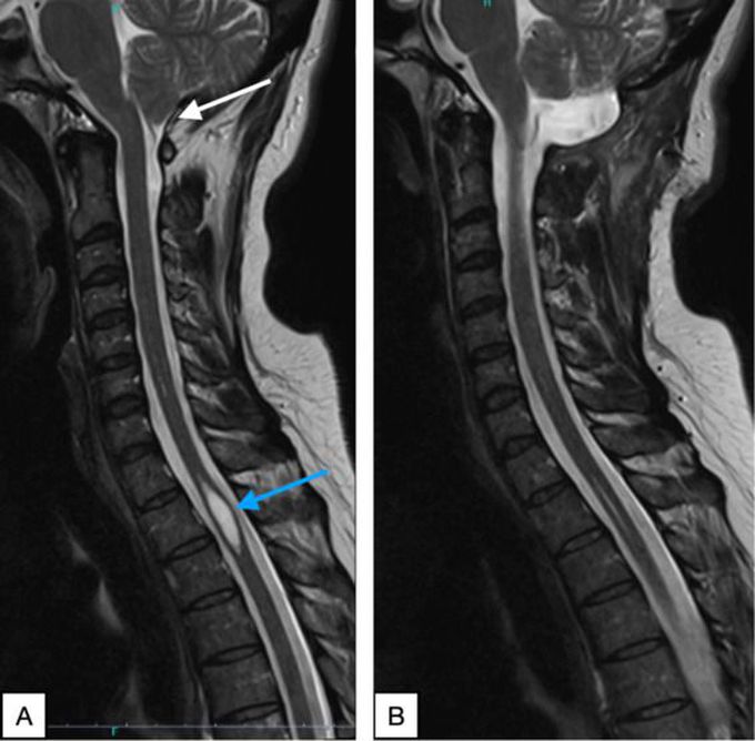 Syringomyelia