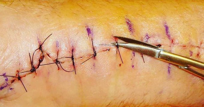 The Suture Removal Time