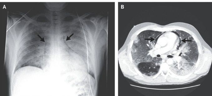 Pneumomediastinum Associated with Influenza A Infection