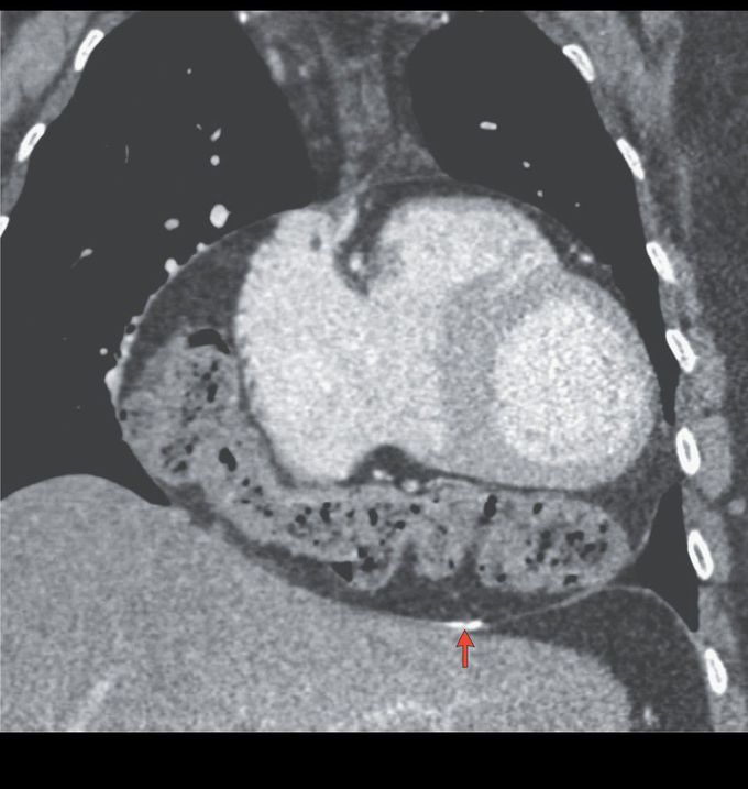 Intrapericardial Colon