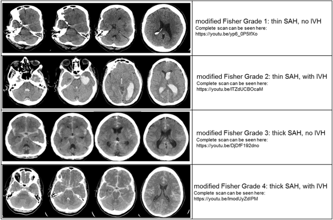 Modified Fisher Scale for Subarachnoid Hemorrhage