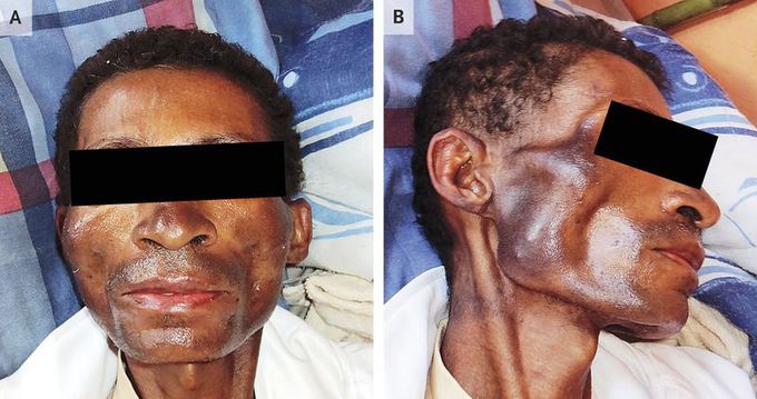 Cutaneous Melanosis in Peripheral Cortisol Resistance