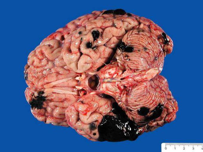 brain metastases of melanoma