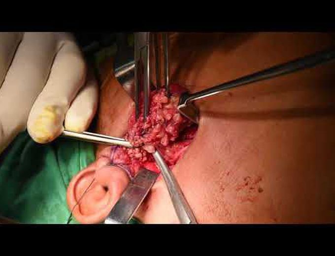 Parotidectomy using a modified facelift incision