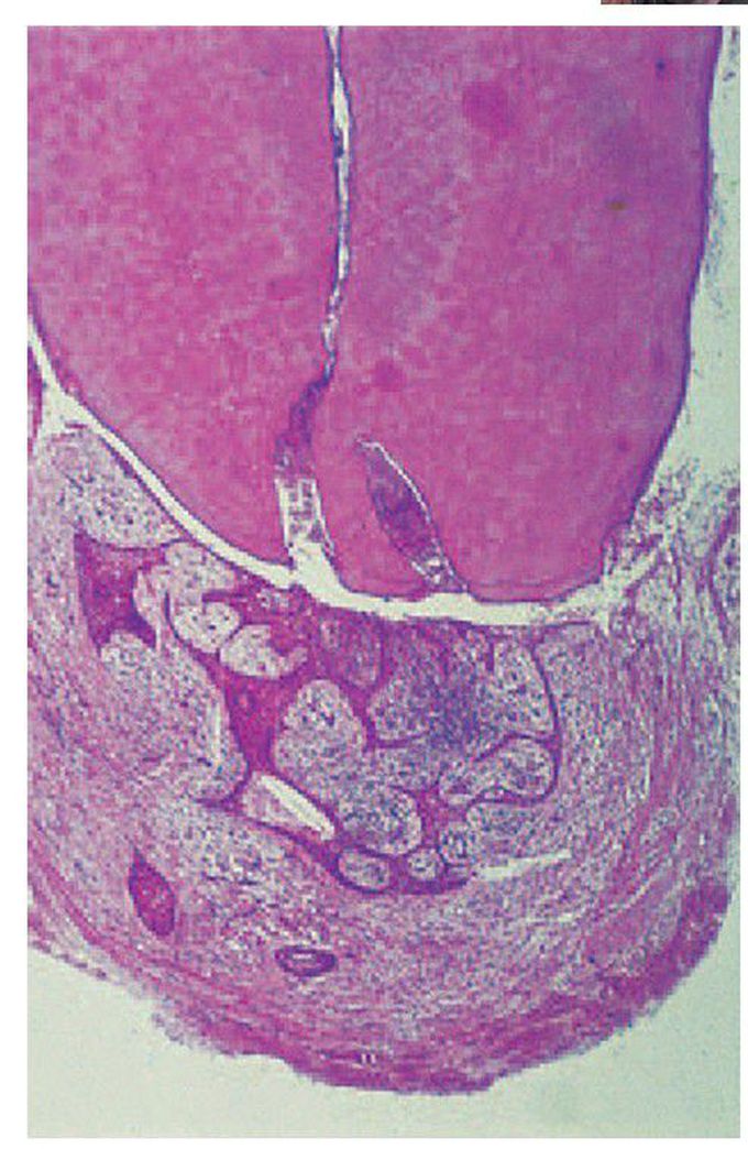 Radicular cyst