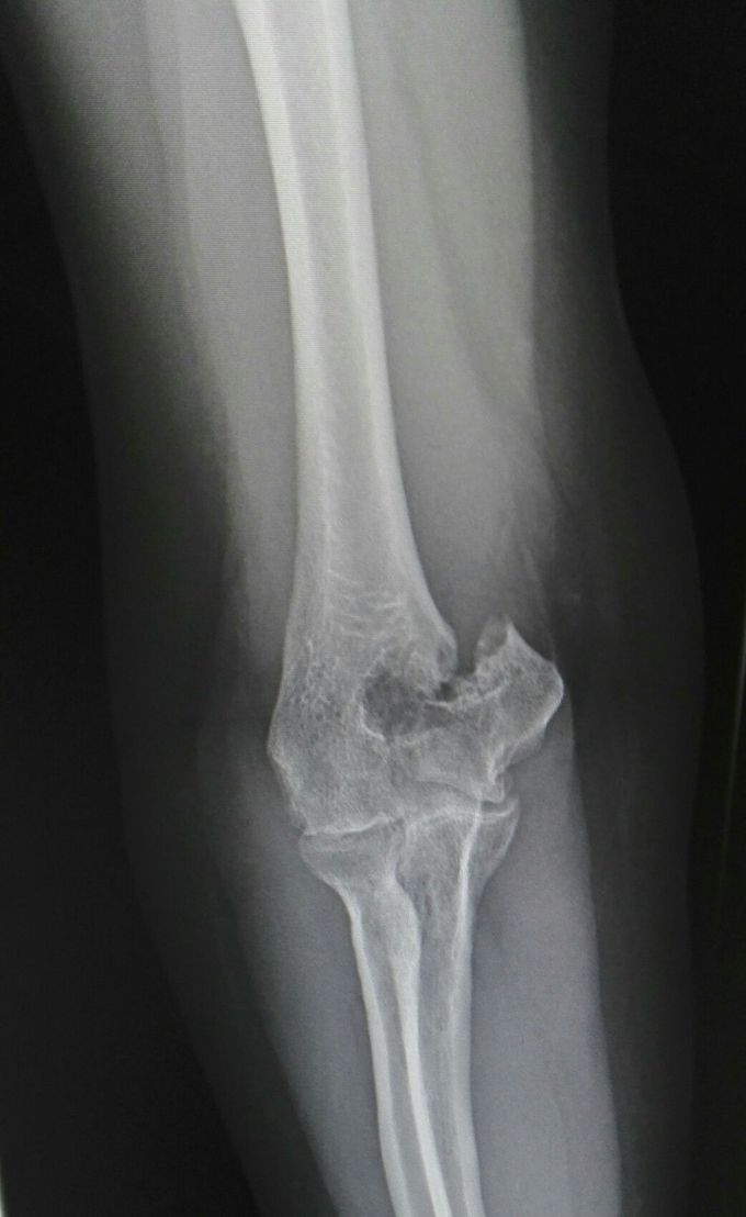 Right elbow AP view