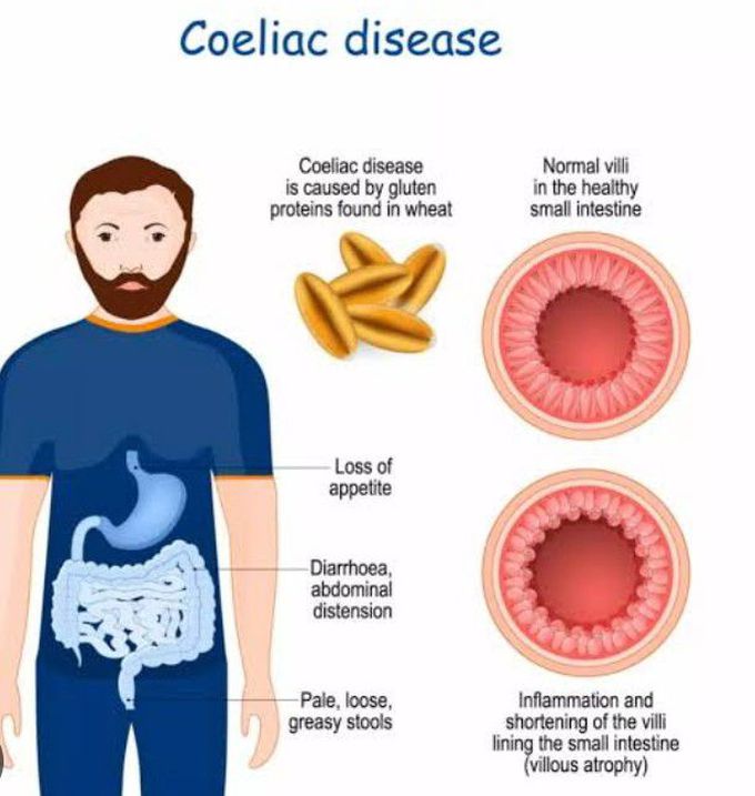 Cause Of Celiac Disease MEDizzy