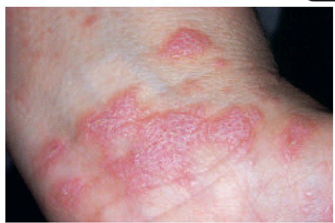Dermal lichen planus.