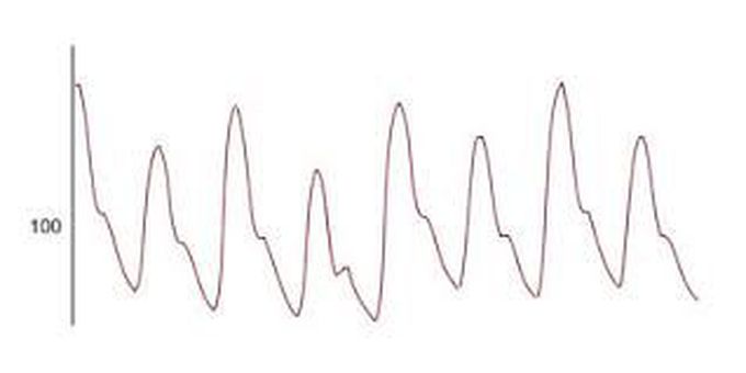 Pulsus Alternans