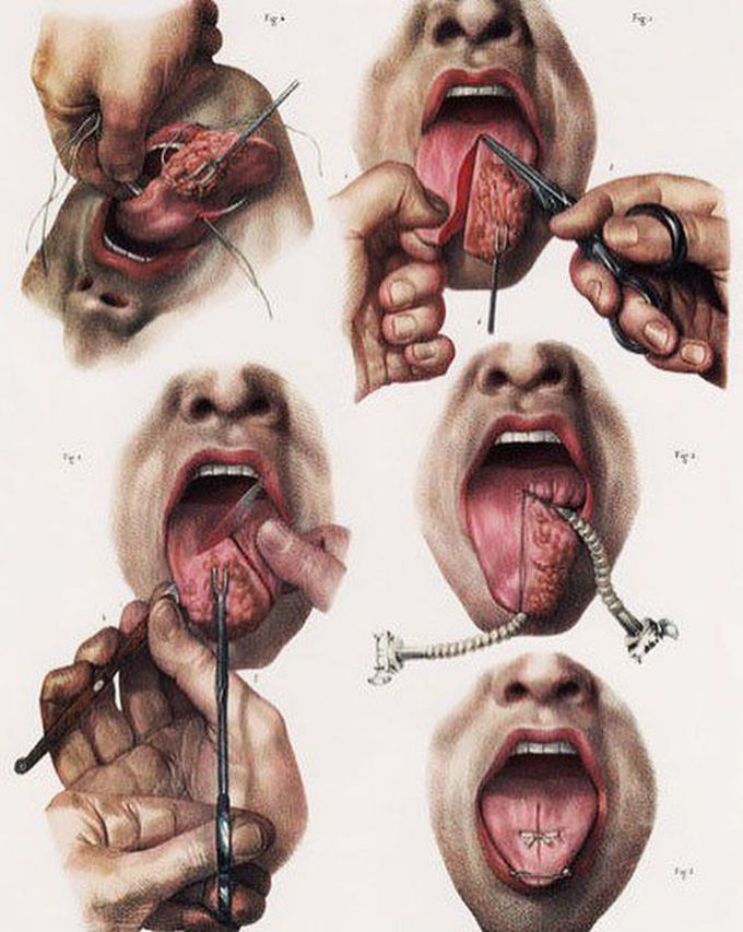 He is cutting the tongue with no anesthesia! 