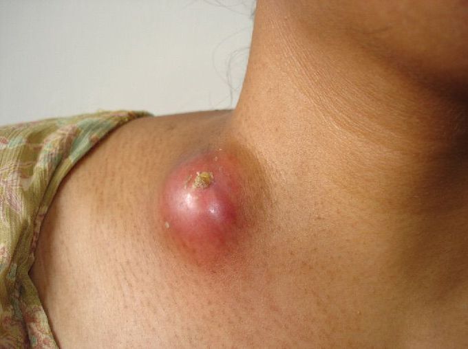 Lymphadenitis