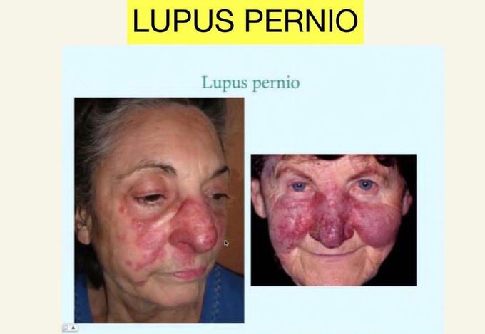 Lupus Pernio