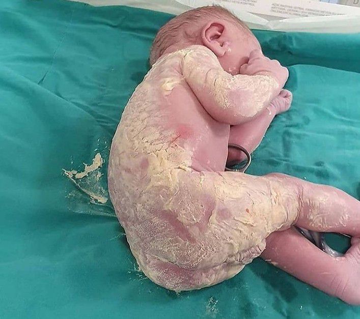 What Is Vernix Caseosa?