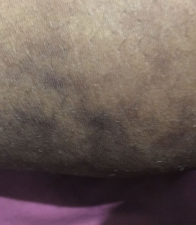 This was found on the calf of my sister ,she is 18..what’s your diagnosis please?