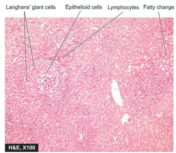 Miliary tuberculosis liver.