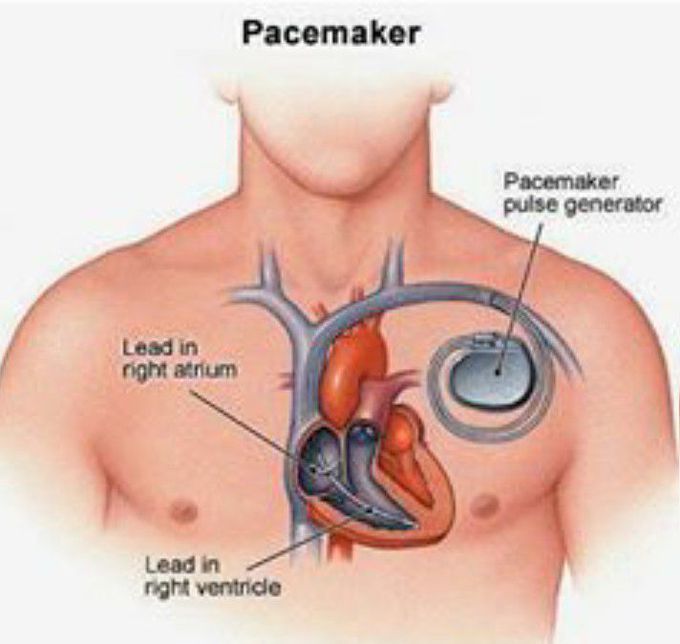 Pacemaker