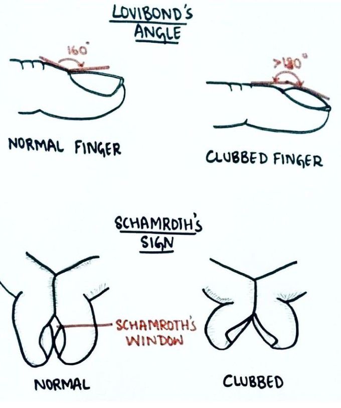 Normal finger Vs clubbed finger