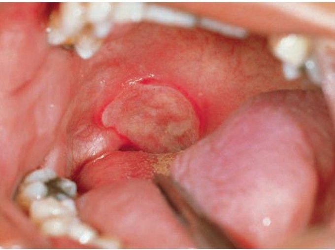 Major aphthous ulcers