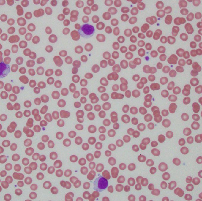 Large Granular Lymphocytic Leukemia