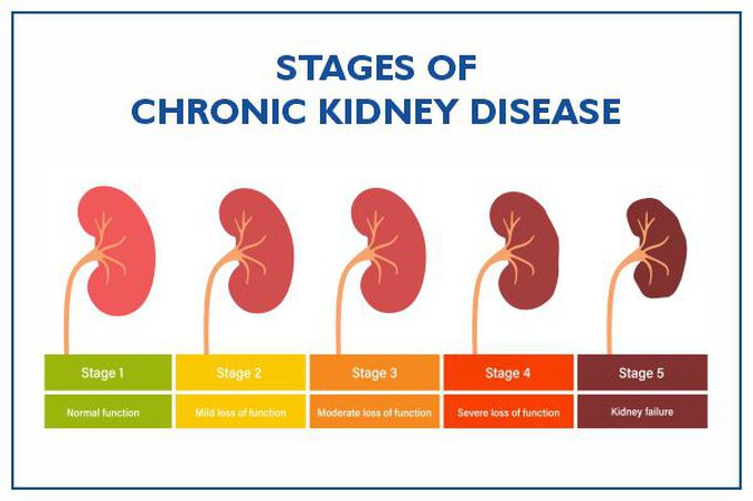 Stages of Chronic Kidney Disease