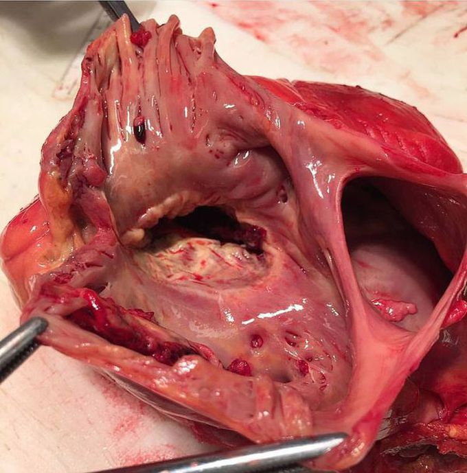 Atrial Septal Defect