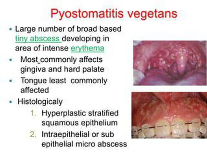 Cause of Pyostomatitis vegetans