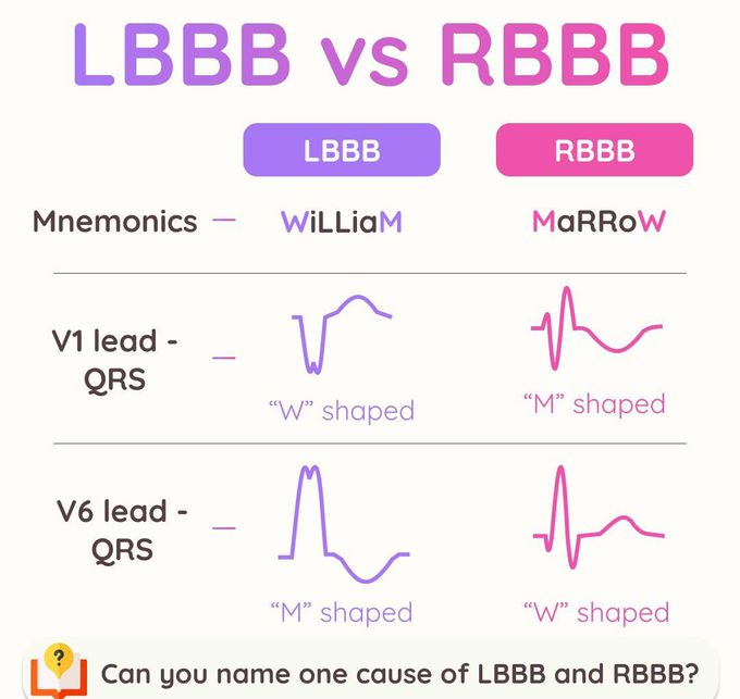 LBBB Vs RBBB