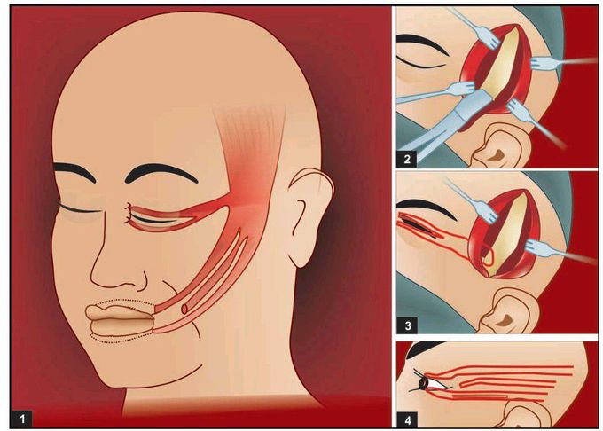 Temporalis transposition